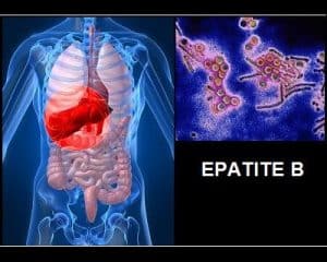 Epatite B