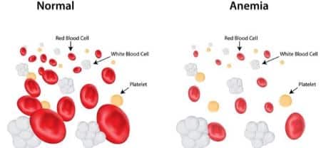 Anemia mediterranea