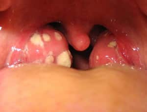 streptococco placche gola
