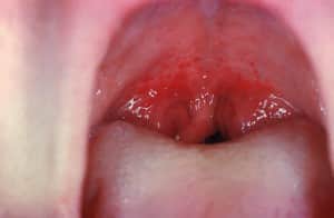 Streptococco tonsille arrossate