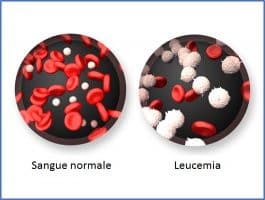 Leucemia