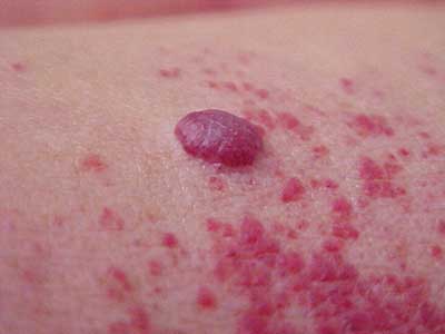 angioma