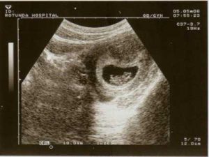 gravidanza-extrauterina-ecografia