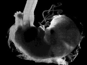 La gravidanza extrauterina è determinata dall'impianto dell'embrione al di fuori della sua normale sede, l'utero, e può diventare pericolosa per la donna se non viene diagnosticata in tempo