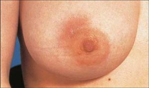 La mastite è una forte infiammazione della mammella che può causare seno duro e infiammazione localizzata o estesa