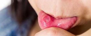 Stomatite lingua