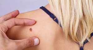 Melanoma donna