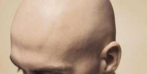 alopecia universale
