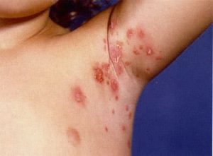 impetigine ascella