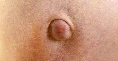 ernia ombelicale