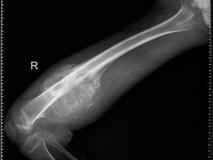 scintigrafia ossea osteosarcoma