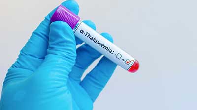 talassemia milza