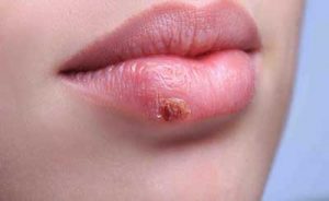 aciclovir herpes