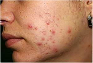 echinacea acne