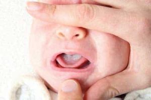 lingua bianca neonato