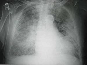 Edema polmonare cardiogeno