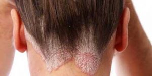 Medrol psoriasi