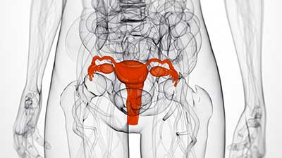 fibroma uterino