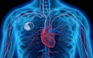 pacemaker impianto