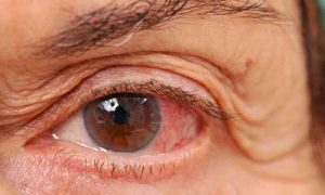 clenil glaucoma