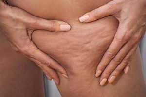 pressoterapia cellulite