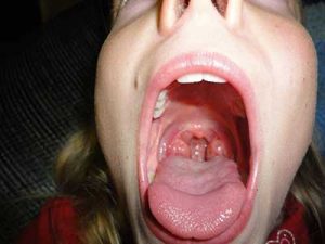 Klacid tonsillite