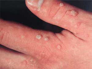 papilloma virus lavarsi le mani